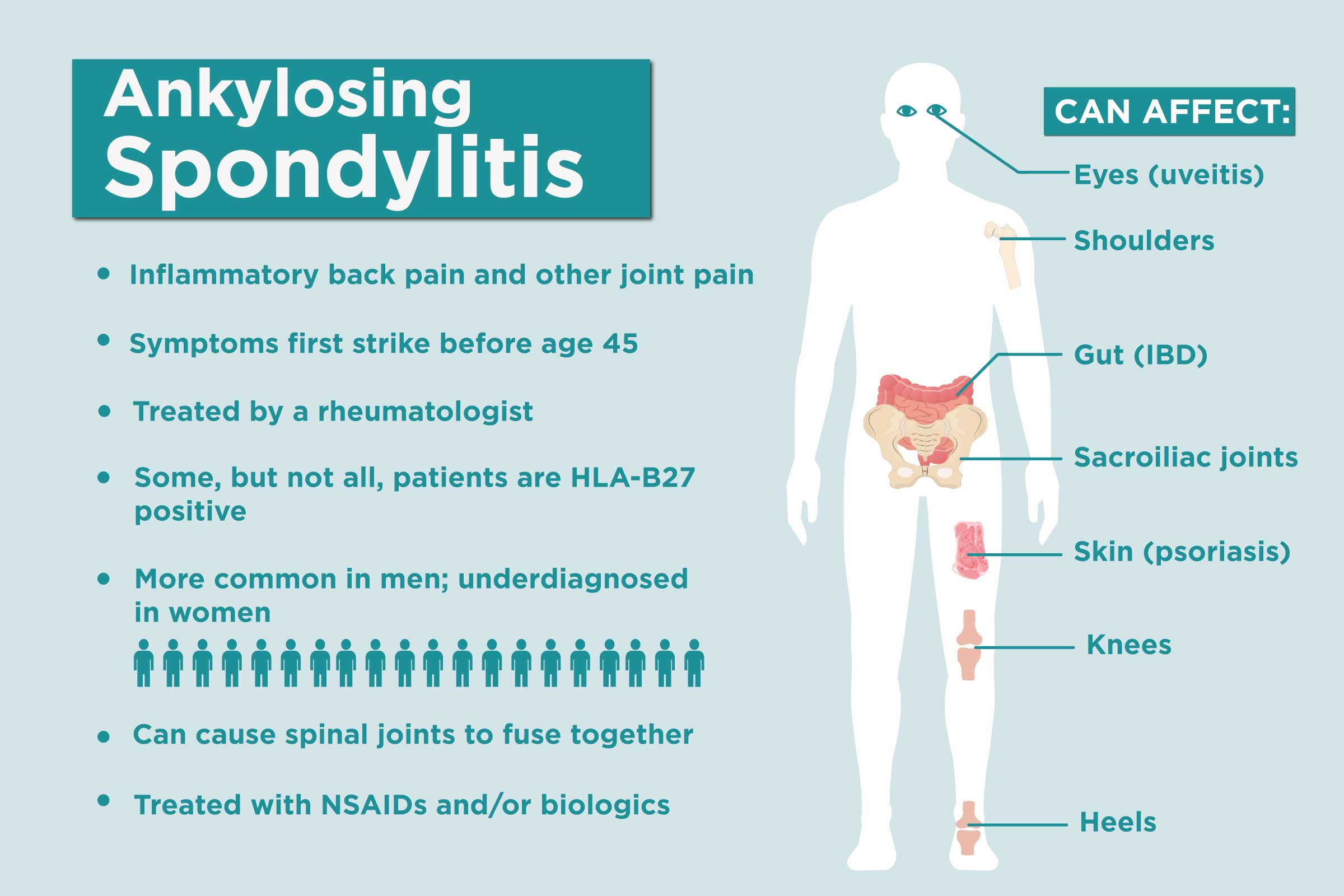 Ankylosing Spondylitis Facts: 17 Things to Know About AS
