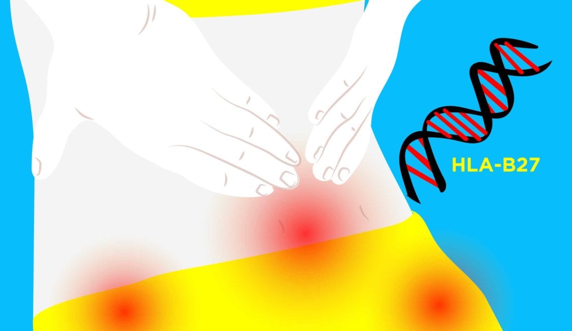 ene and Ankylosing Spondylitis