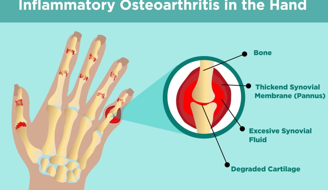 Inflammatory Osteoarthritis in Hands