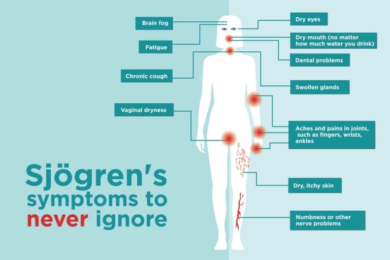 Sjögrens Syndrome Symptoms You Might Be Ignoring
