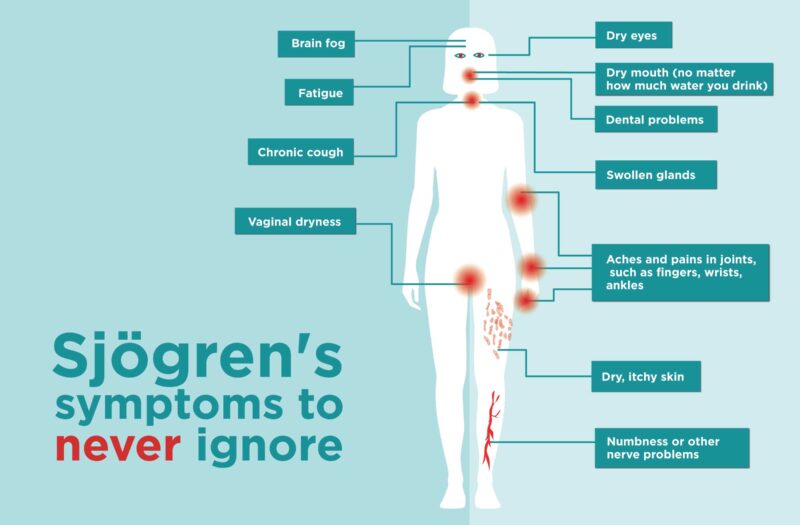 Sjogren's Syndrome Symptoms Sjogren's Syndrome Symptoms
