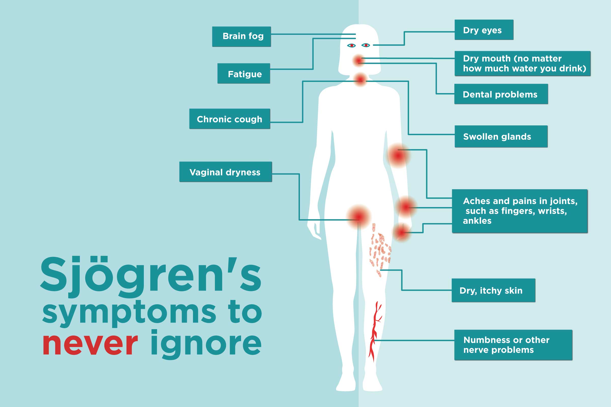 Sjögrens Syndrome Symptoms You Might Be Ignoring