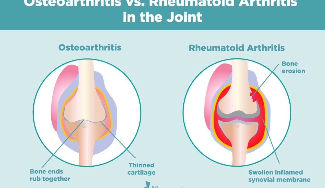 Osteoarthritis vs Rheumatoid in the Joint