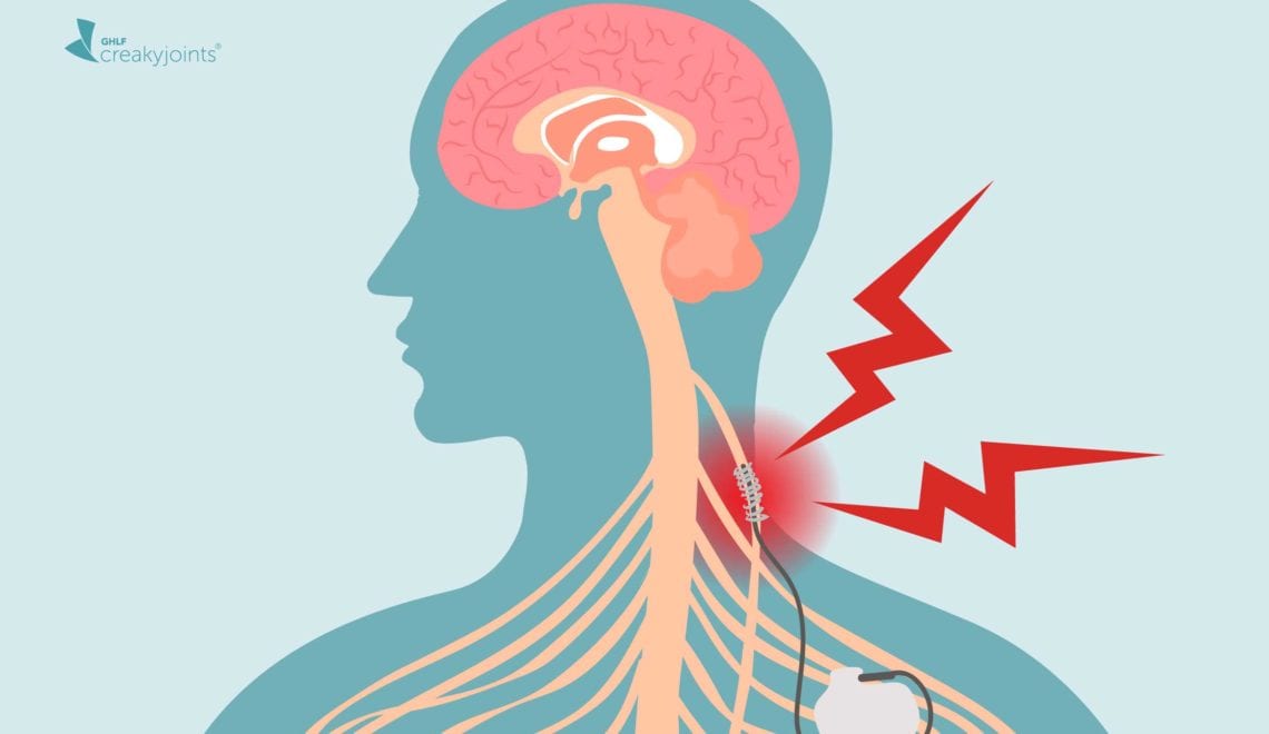 Vagus Nerve Stimulation Rheumatoid Arthritis