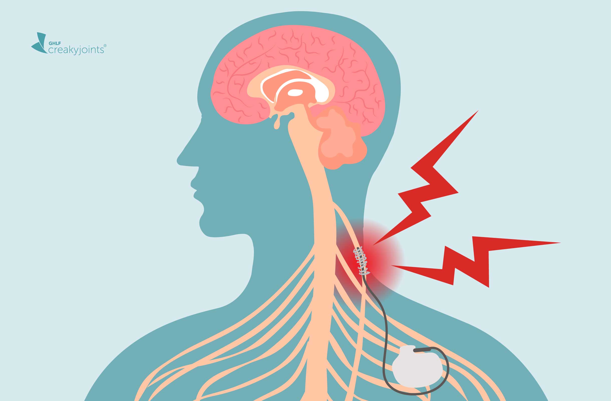 Transcutaneous auricular vagus nerve stimulation as a potential