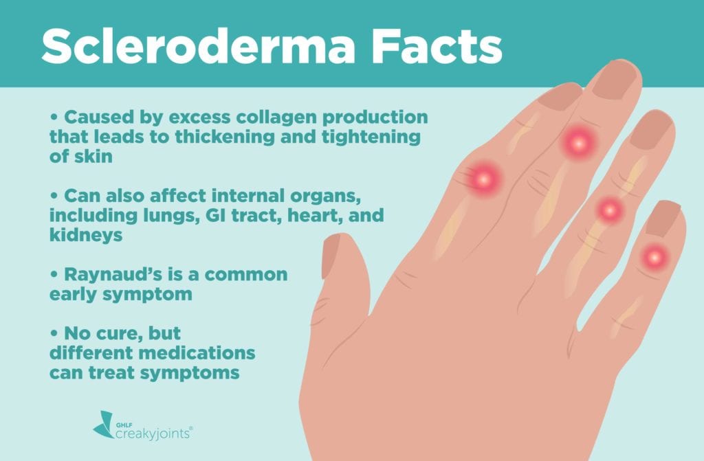 Systemic Scleroderma Hands