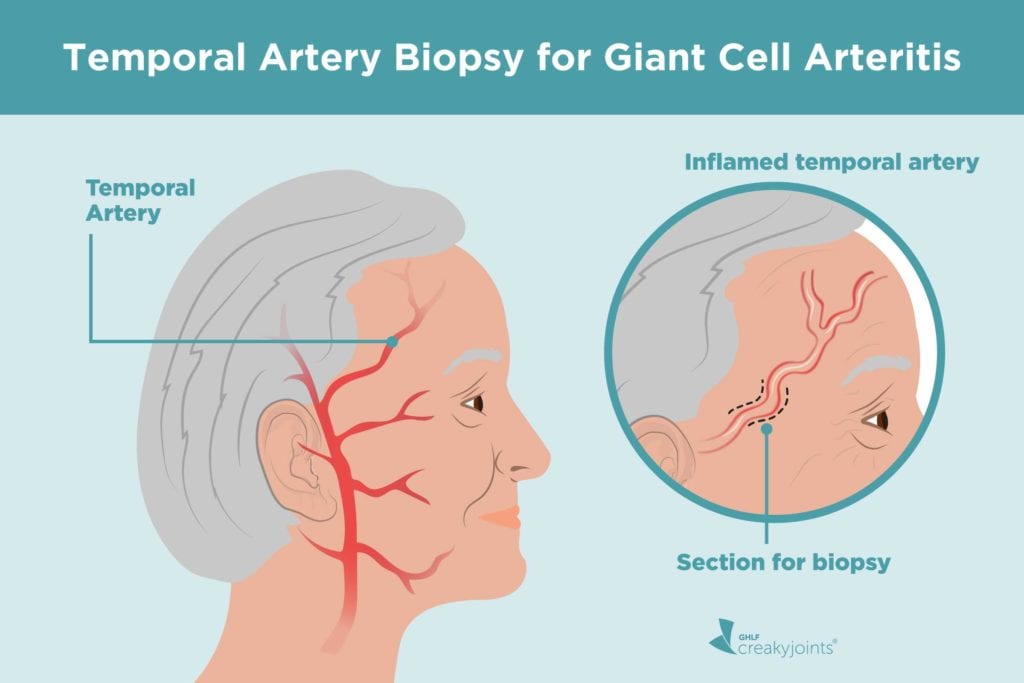 Temporal Artery Biopsy How It Diagnoses Giant Cell Arteritis