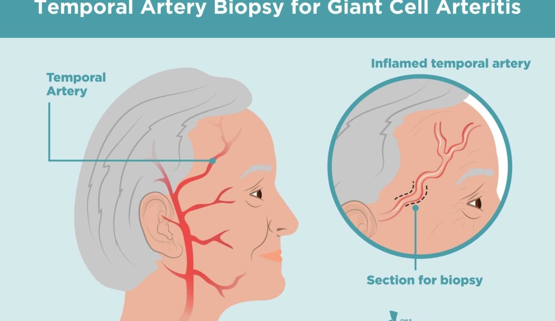 Temporal Artery Biopsy for Giant Cell Arteritis