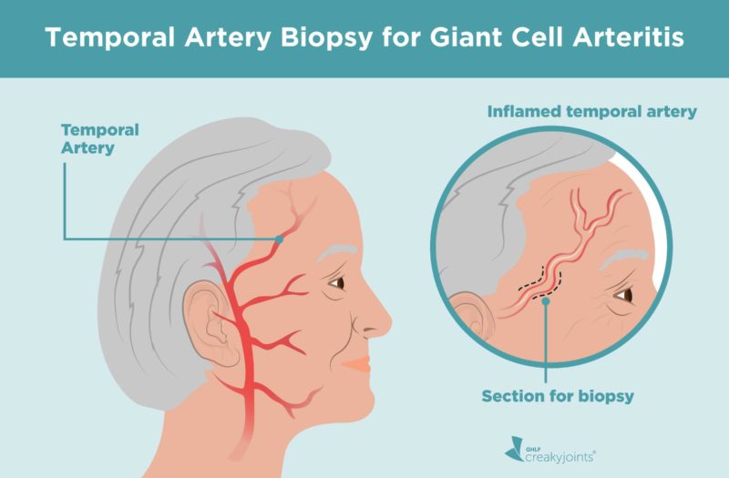 Temporal Artery Biopsy for Giant Cell Arteritis