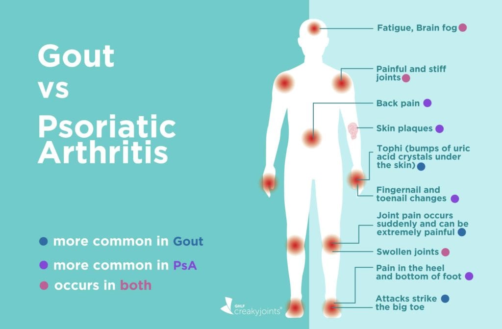 Gout vs. Psoriatic Arthritis: Differences in Symptoms and Treatments