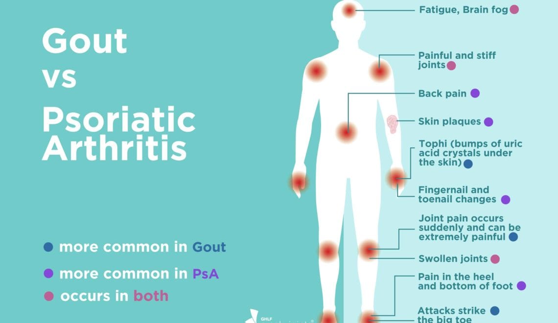 Gout vs Psoriatic Arthritis