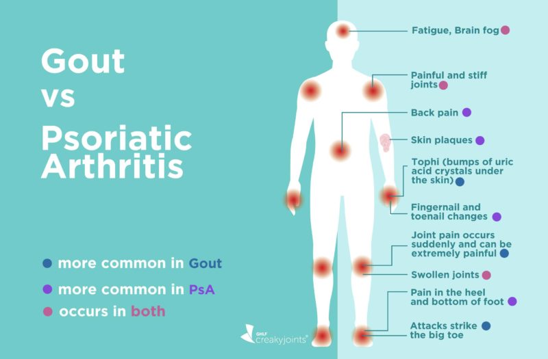 Gout vs Psoriatic Arthritis