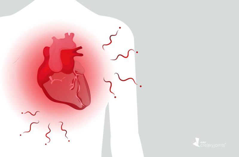 Heart Inflammation Arthritis