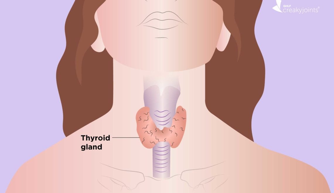 Hypothyroidism and Arthritis