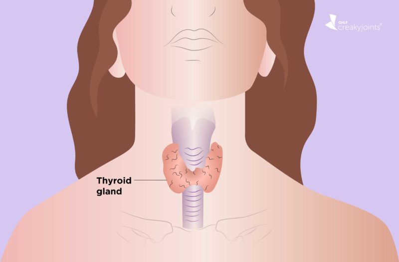 Hypothyroidism and Arthritis