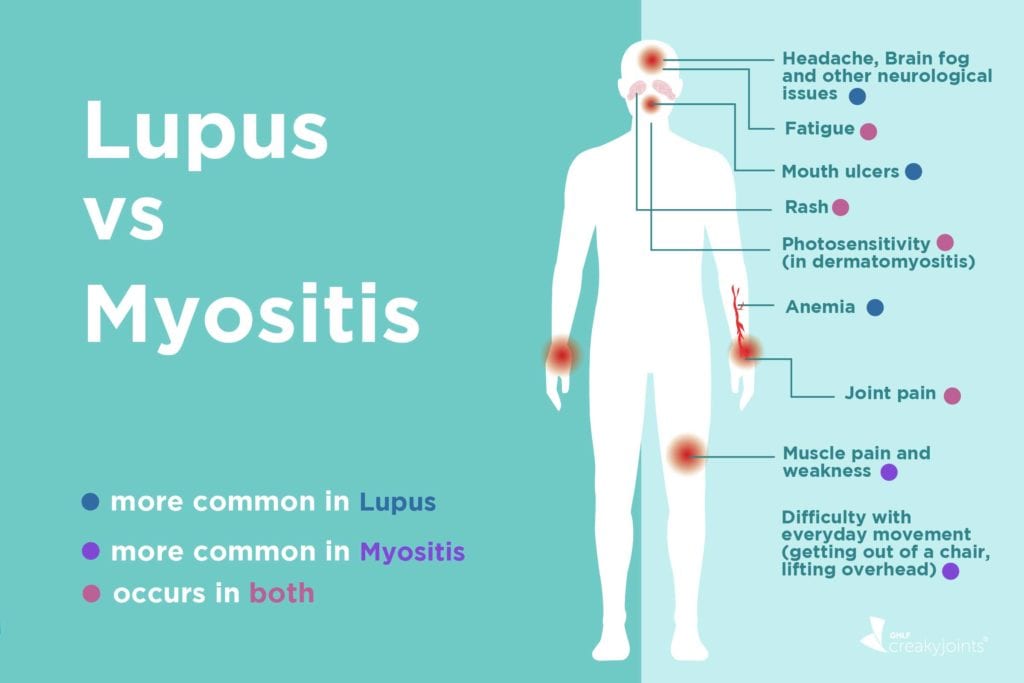 lupus and rheumatoid arthritis symptoms