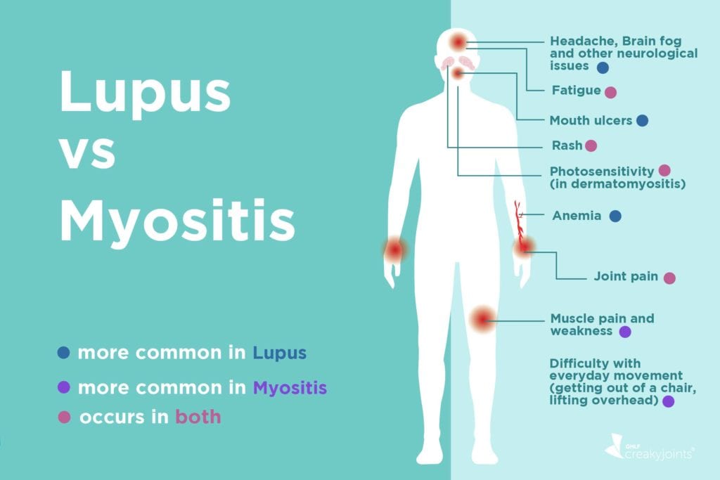 lupus-vs-myositis-differences-in-symptoms-and-treatments