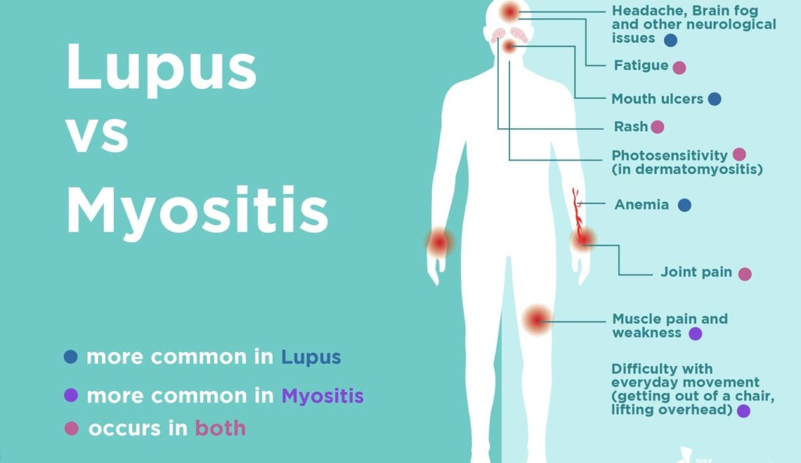 Lupus vs. Myositis