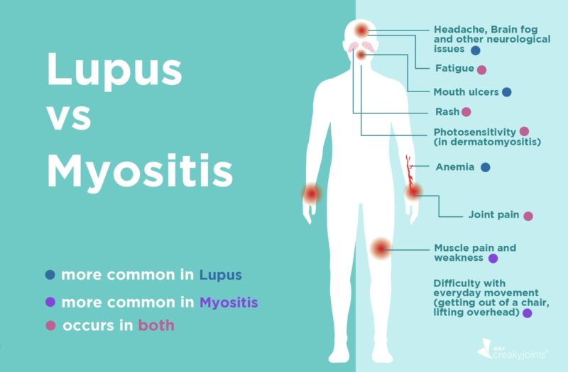 Lupus vs. Myositis: Differences in Symptoms and Treatments