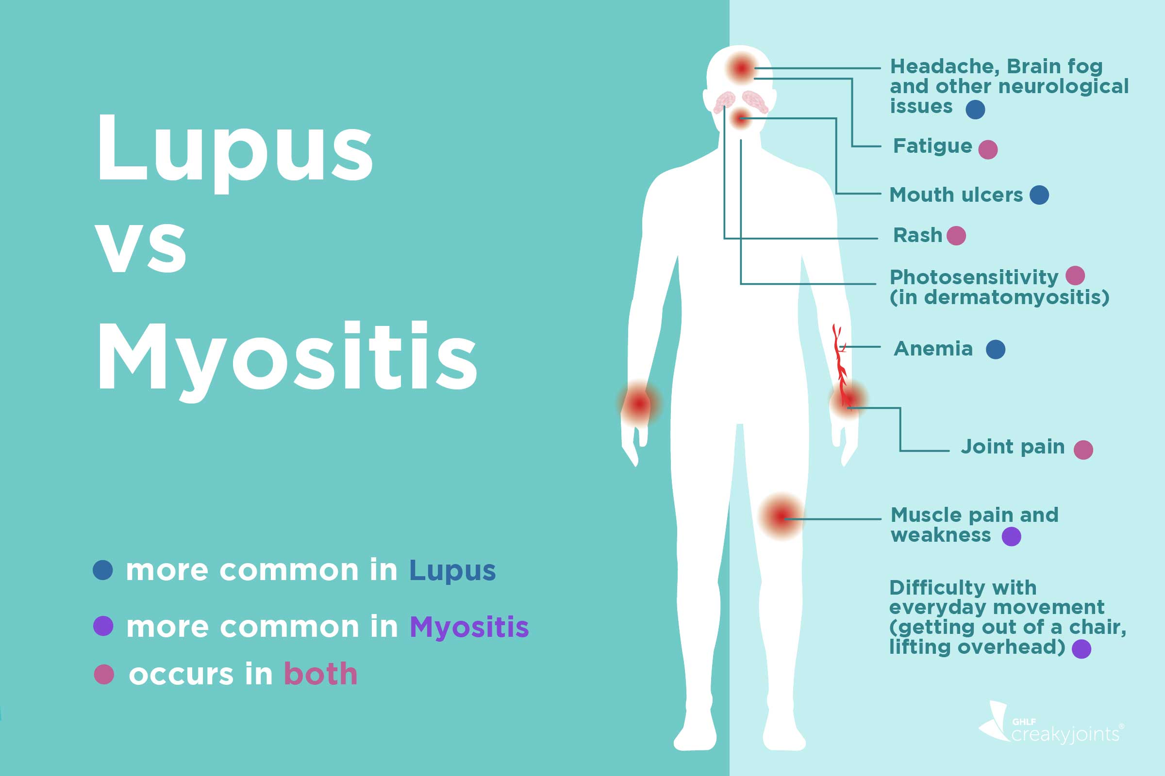 Lupus Myositis: Differences in Symptoms and Treatments