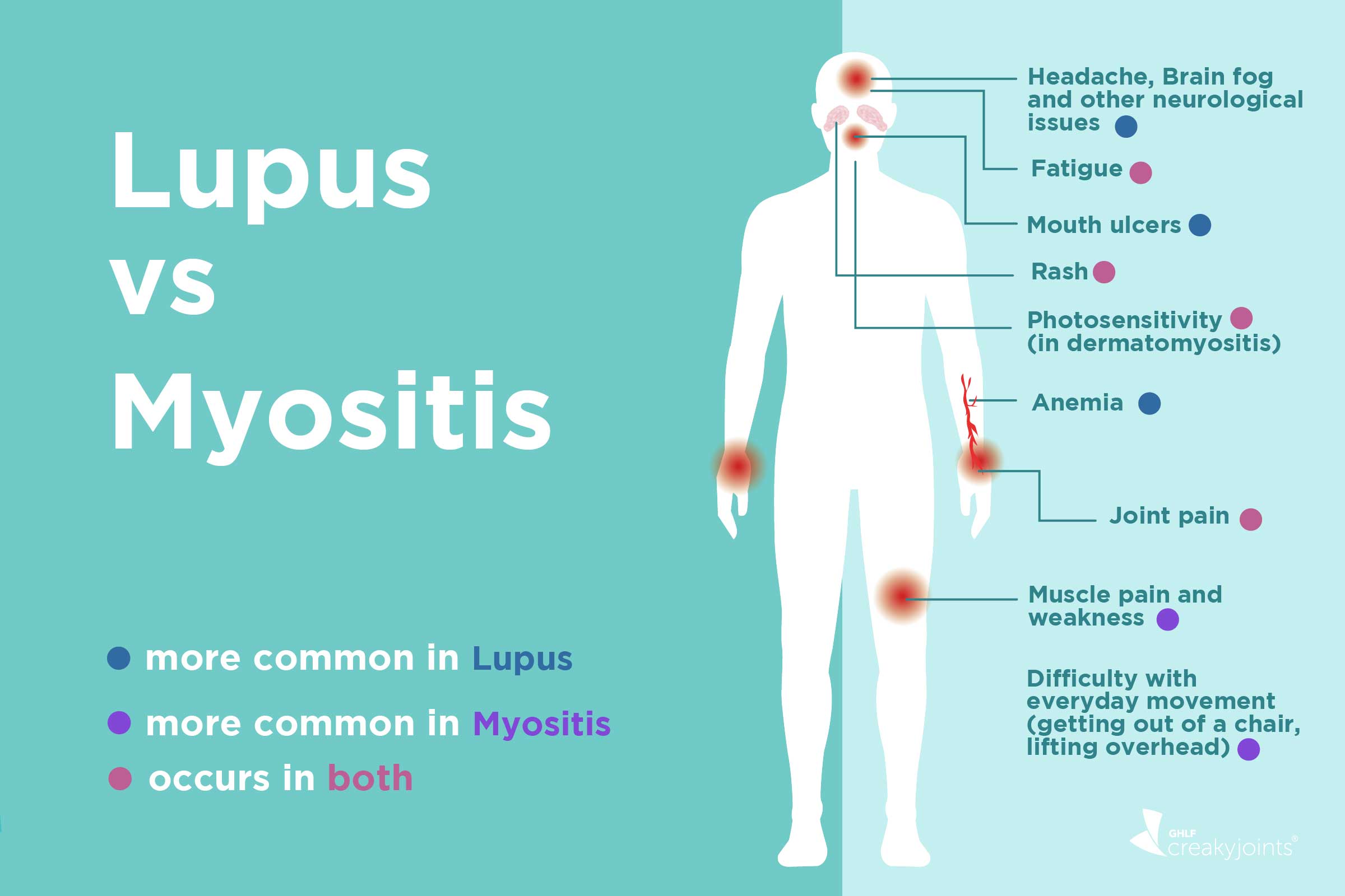 Lupus vs. Myositis: Differences in Symptoms and Treatments