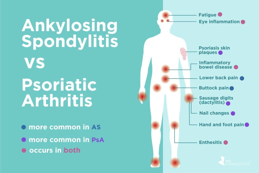 Ankylosing Spondylitis vs. Psoriatic Arthritis Differences in Symptoms