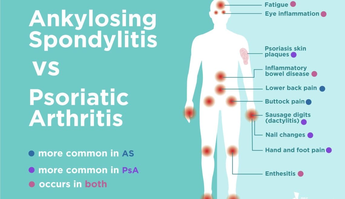 Psoriatic Arthritis vs. Ankylosing Spondylitis