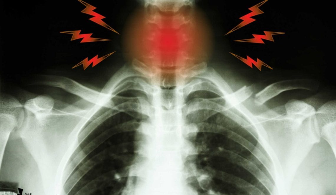 Esophageal Scleroderma