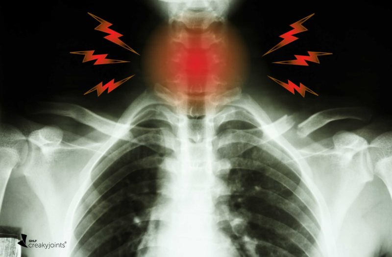 Esophageal Scleroderma