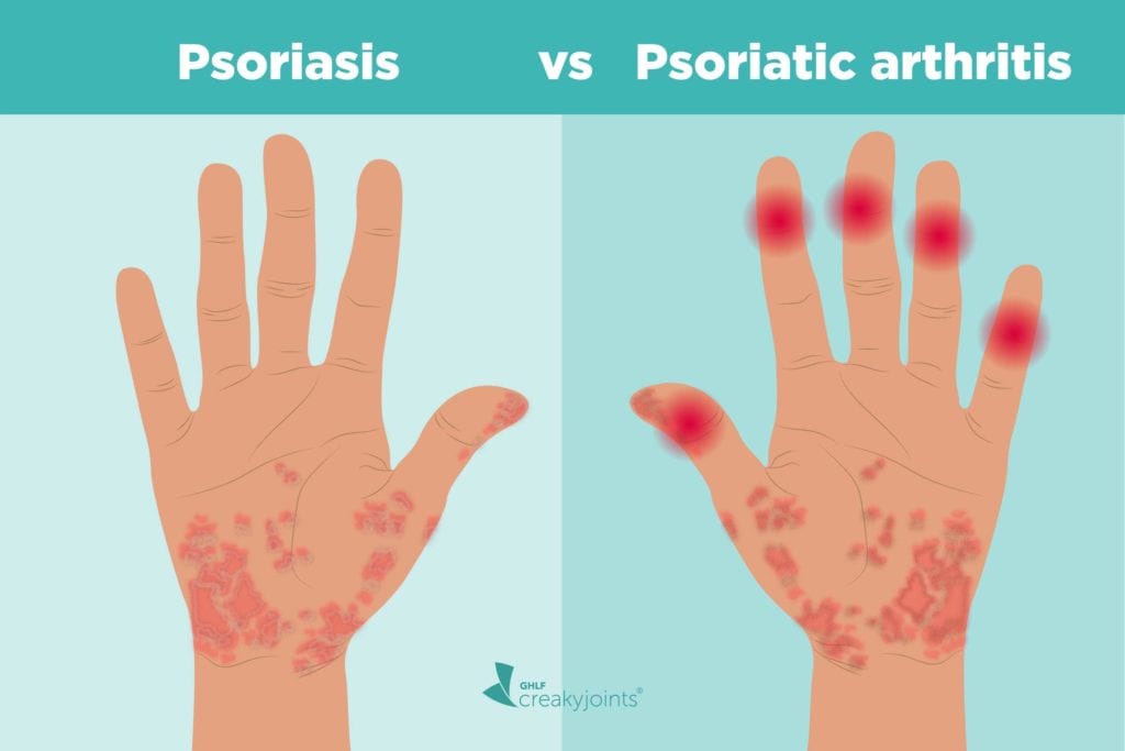 Psoriasis vs Psoriatic arthritis