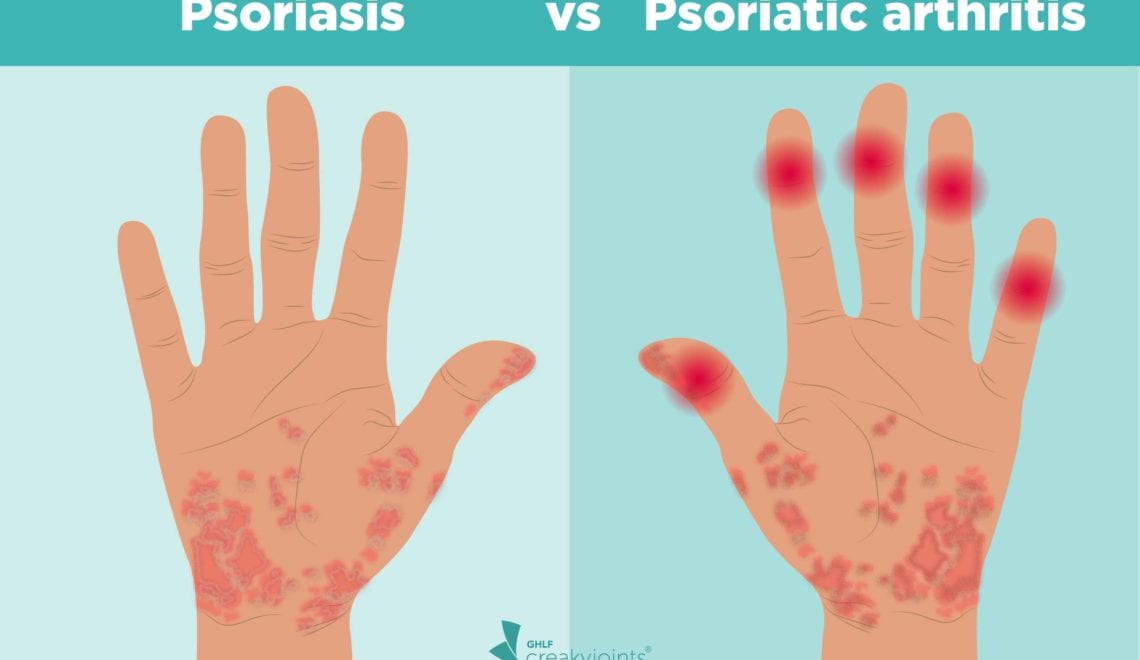 Psoriasis and Psoriatic Arthritis Connection