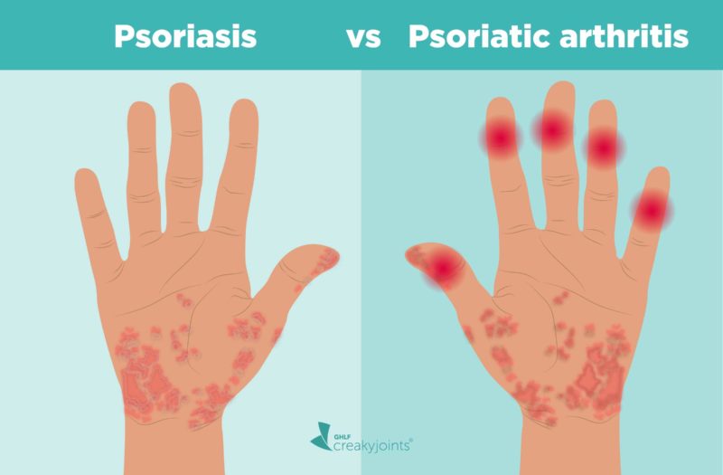 Psoriasis and Psoriatic Arthritis Connection
