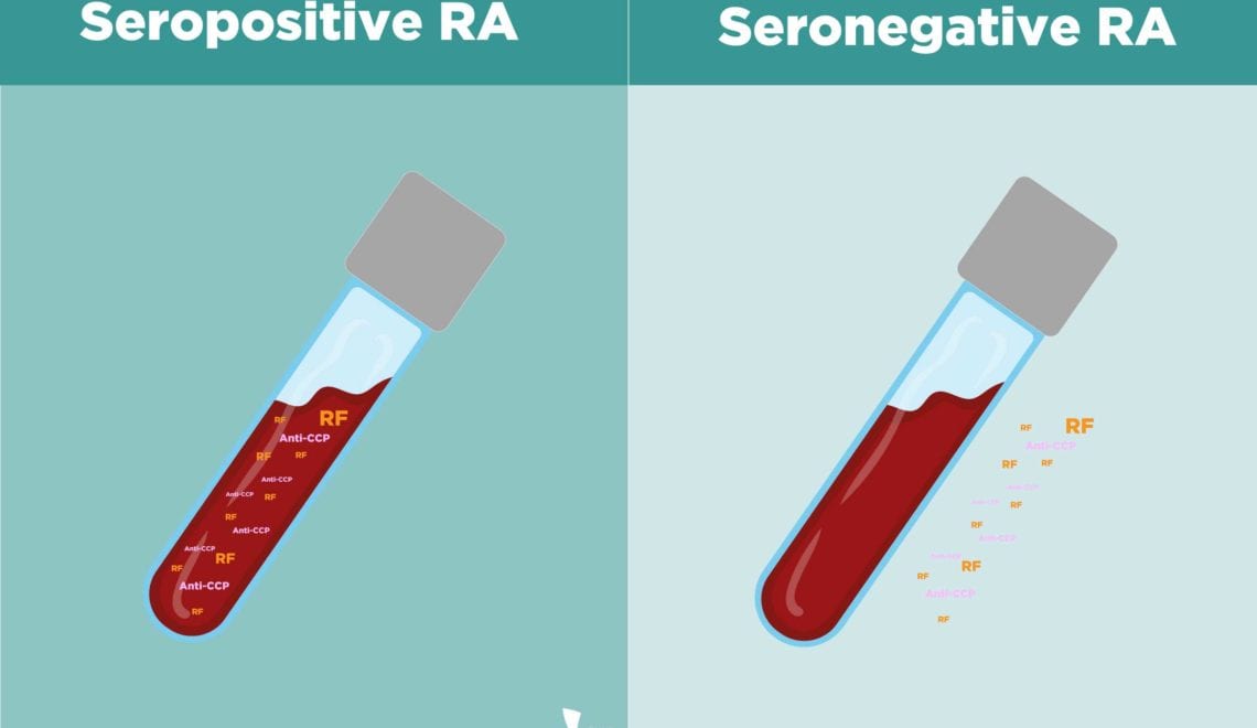 Seropositive RA vs Seronegative RA