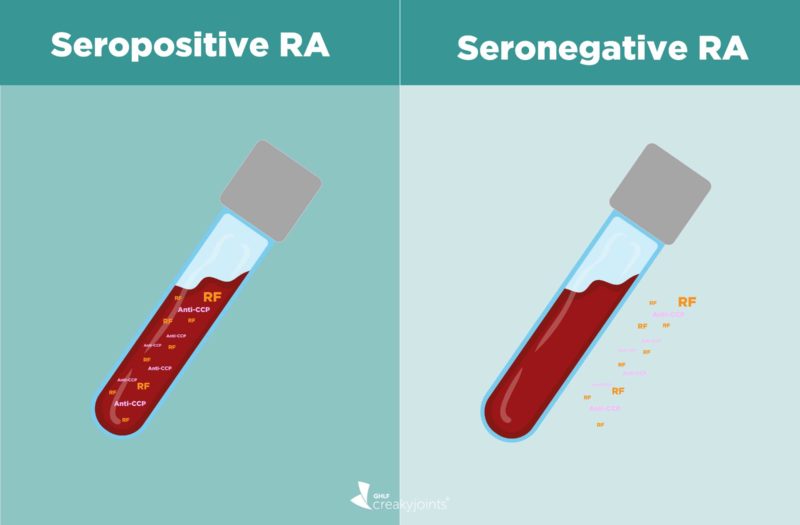 Seropositive RA vs Seronegative RA