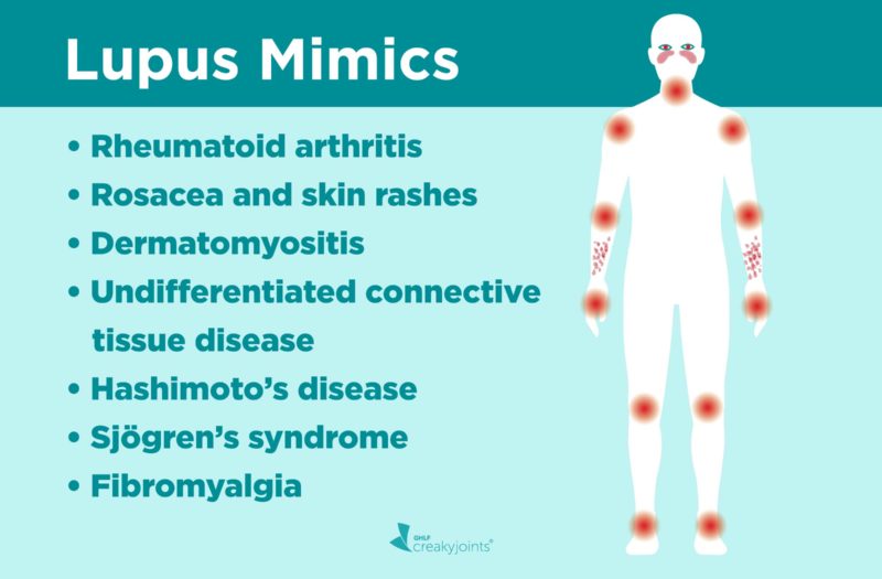 Lupus misdiagnosis