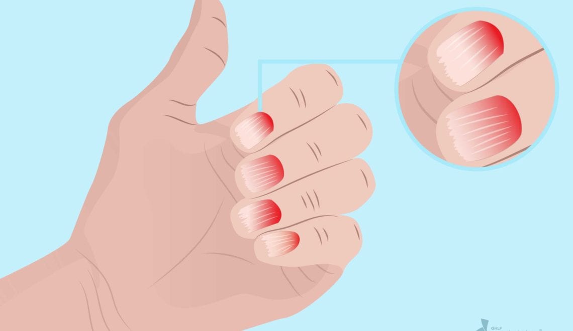 Caring for Nails with Psoriasis