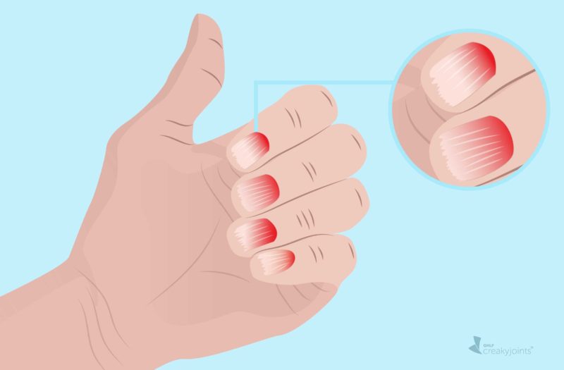 Caring for Nails with Psoriasis