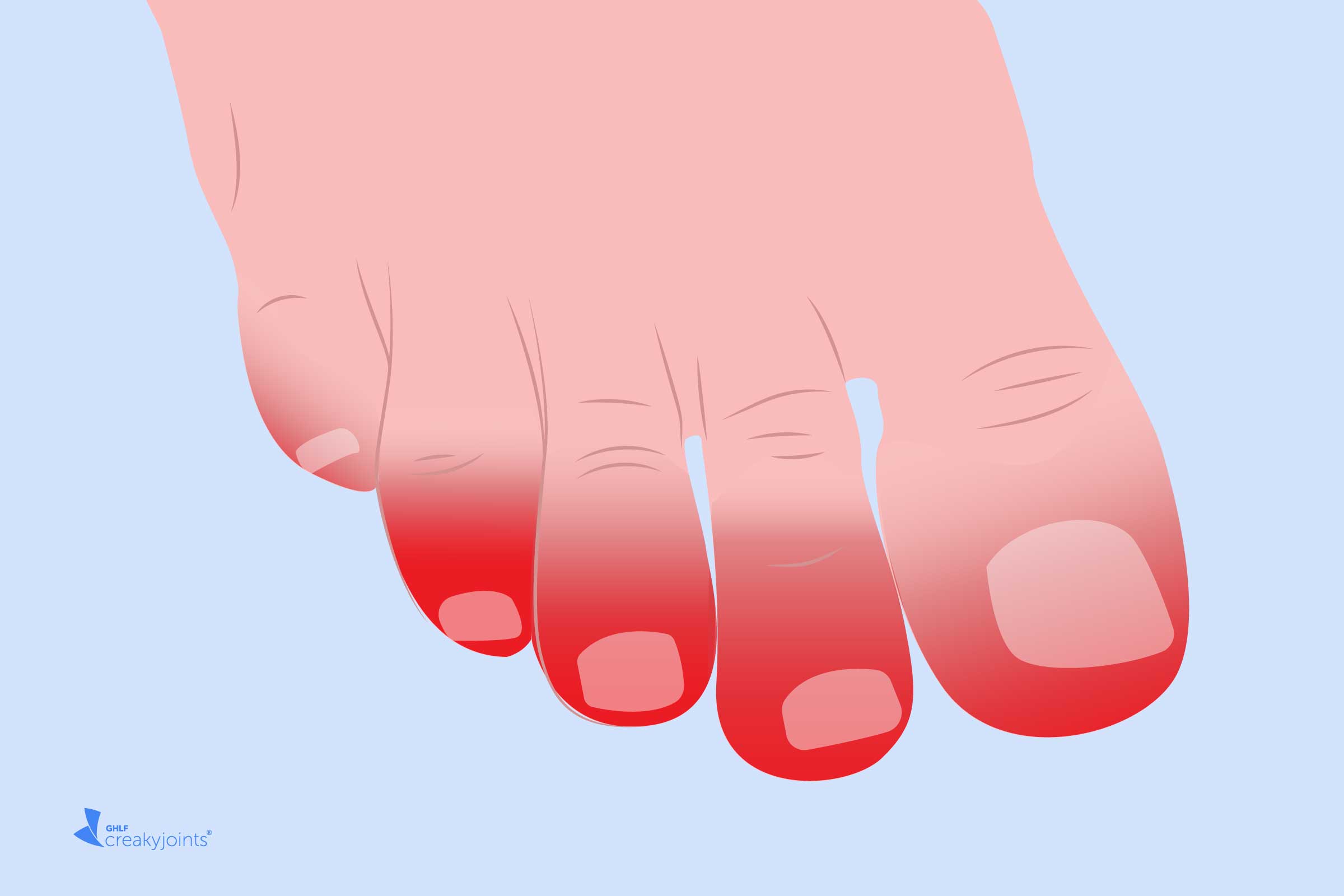 COVID-19 Skin Symptoms: 'COVID Toes,' Rashes, and More