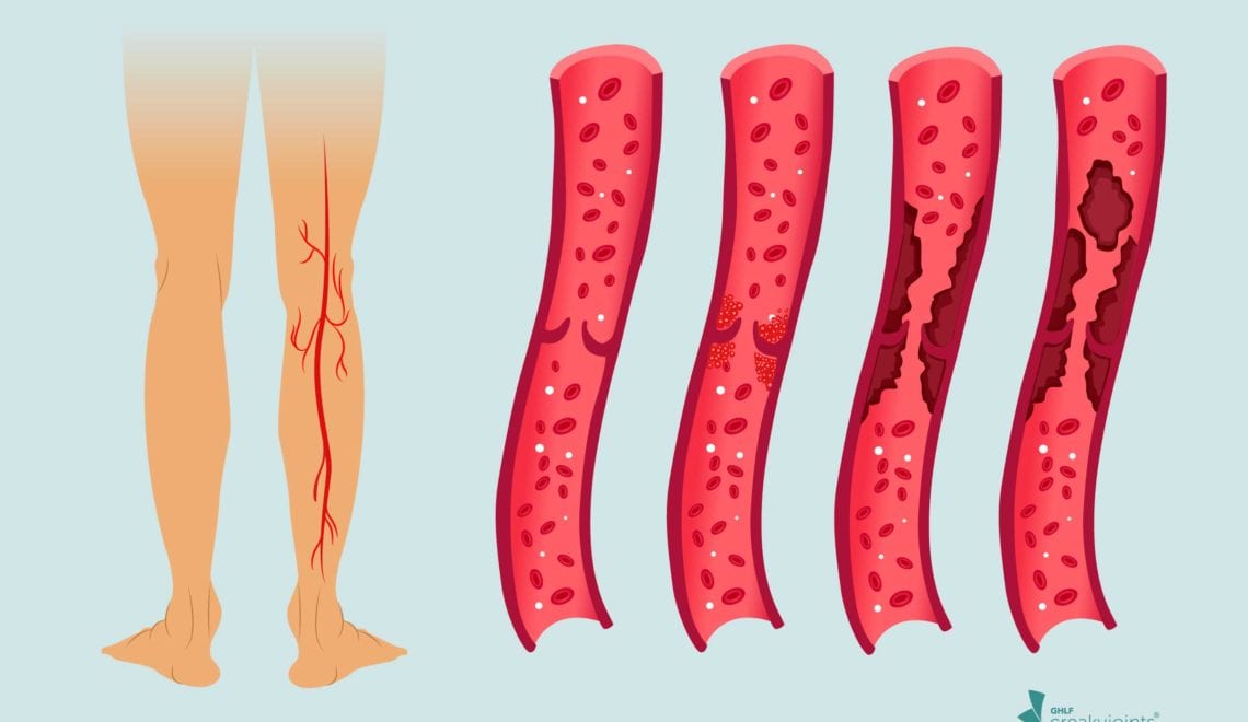 Blood Clots in Legs