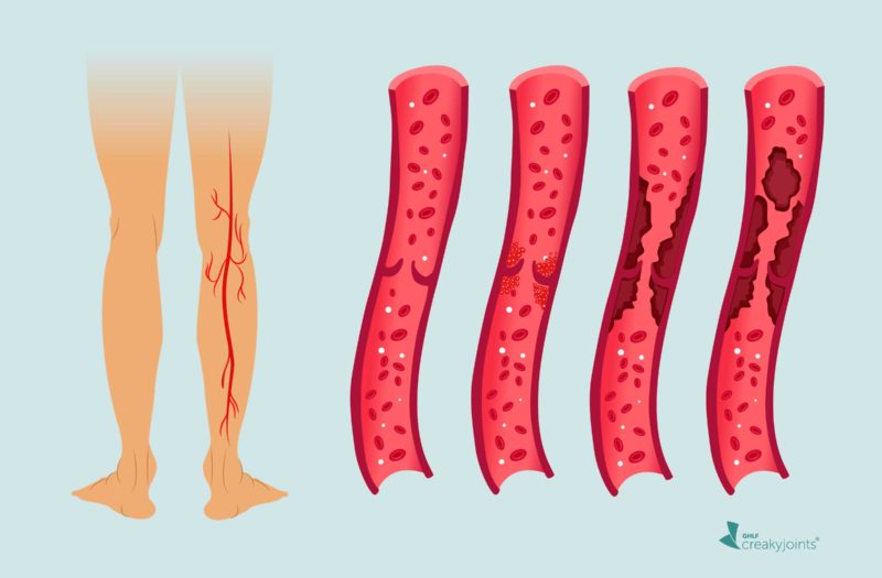 Blood Clots in Legs