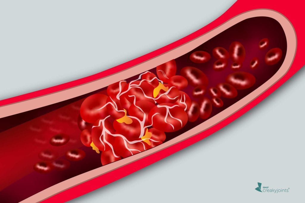 Rheumatoid Arthritis Raises Blood Clot Risk; Controlling Disease