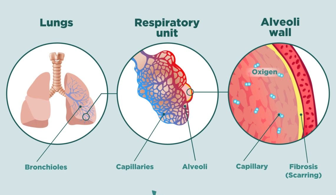 Interstitial Lung Disease