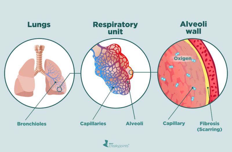 Interstitial Lung Disease