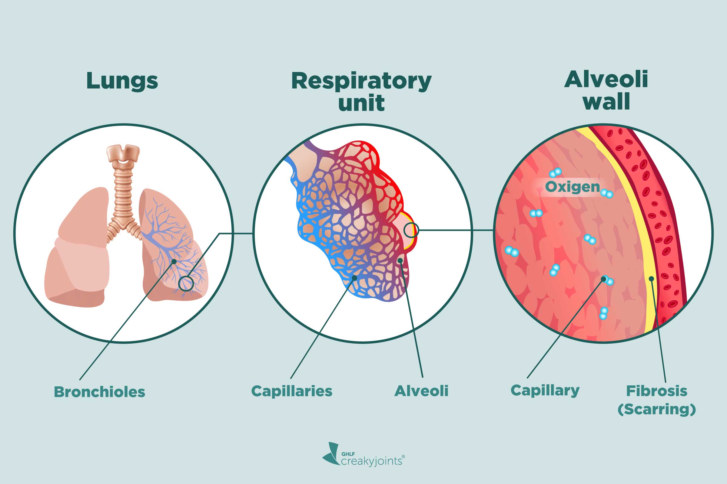 interstitial-lung-disease-causes-symptoms-stages-diagnosis-treatment-images