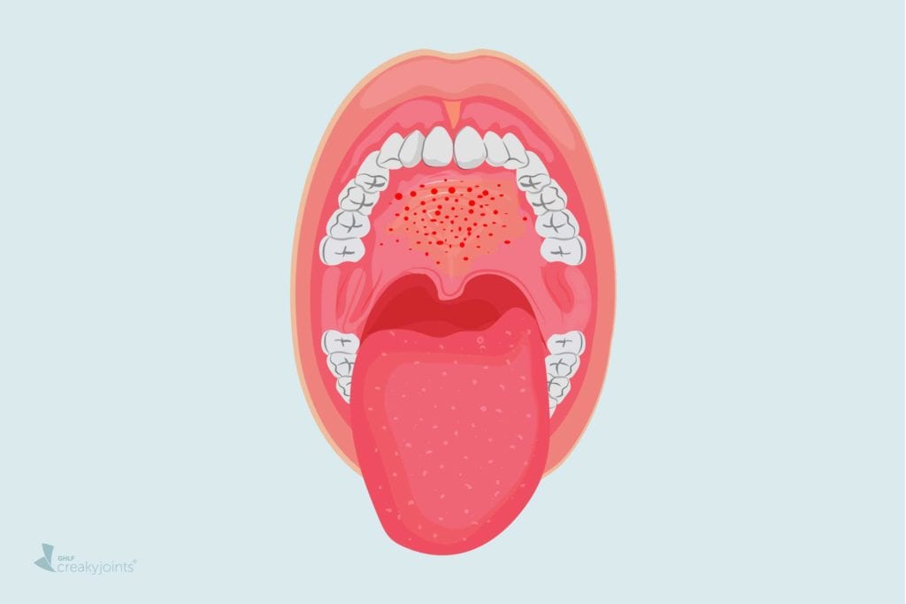 20+ Are Blisters On Your Tongue A Sign Of Covid