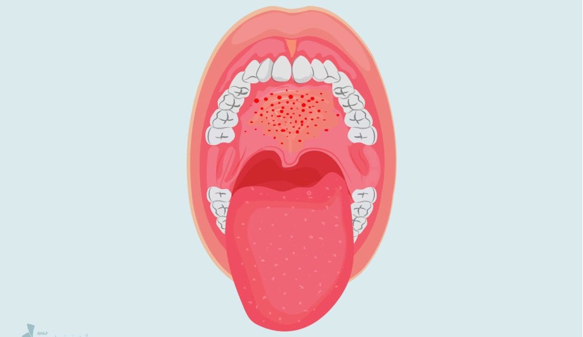 COVID-19 Mouth Lesions