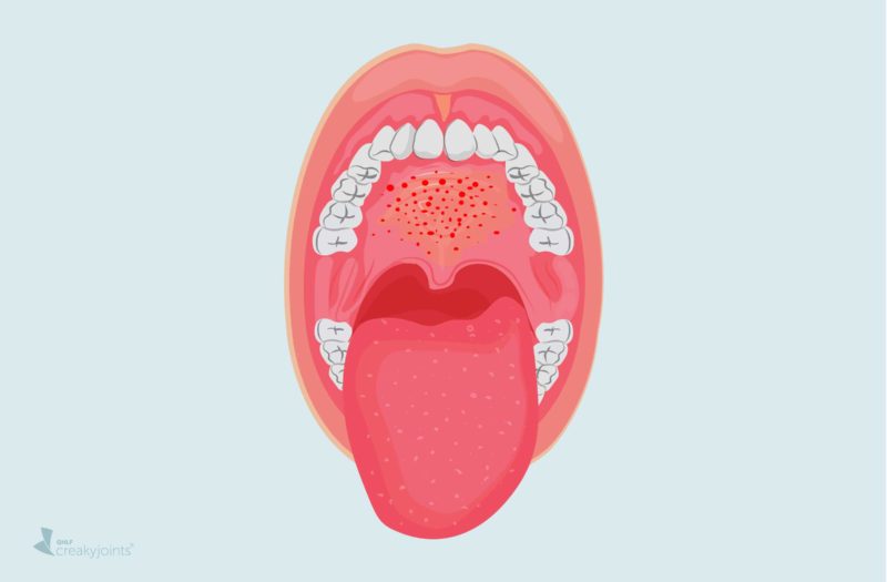 COVID-19 Mouth Lesions