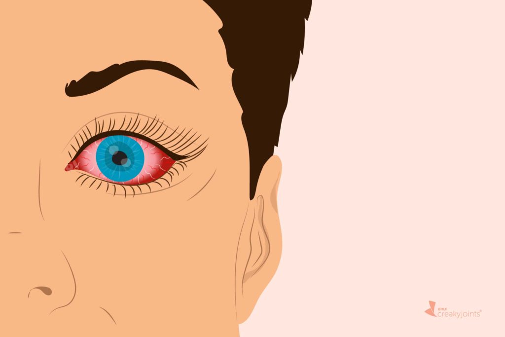Knowing What Pink Eye Looks Like