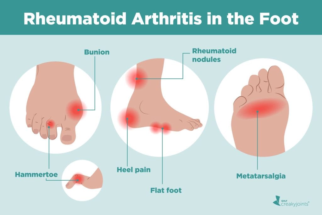 Rheumatoid Arthritis in the Feet Symptoms and Treatments