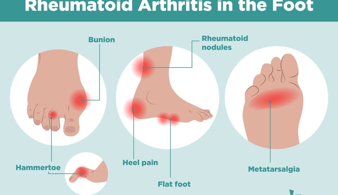 Rheumatoid Arthritis in the Feet